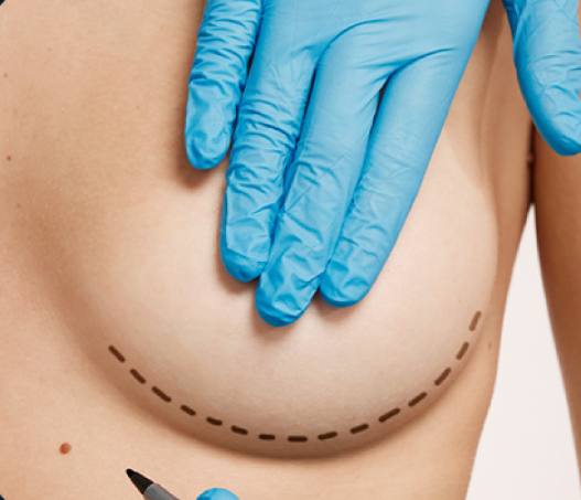 Silicone ou Mastopexia? Qual a diferença?