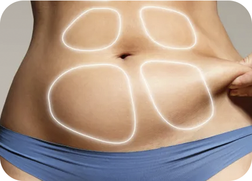 Abdominoplastia HD