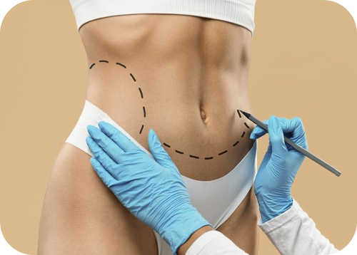 Abdominoplastia