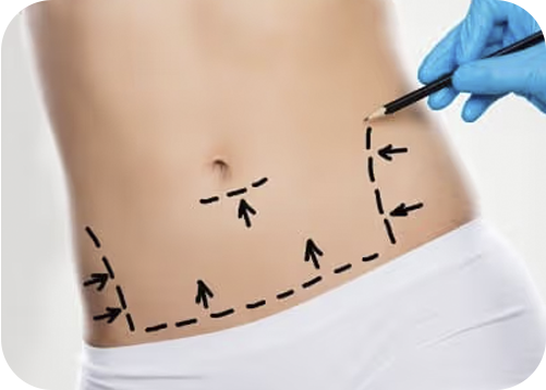 Miniabdominoplastia