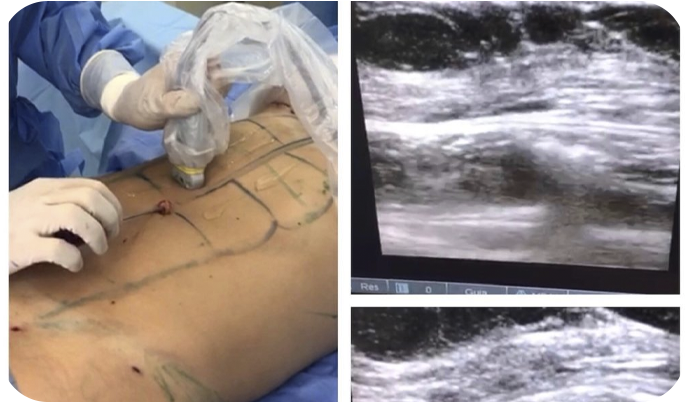 Enxerto de gordura por ultrassom